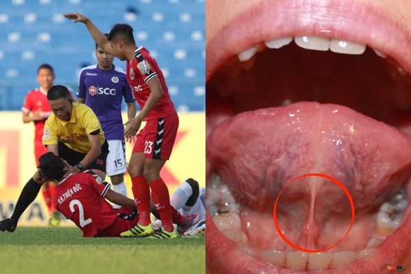 Nuốt lưỡi trong bóng đá là hiện tượng gây nên nhiều nguy hiểm nghiêm trọng
